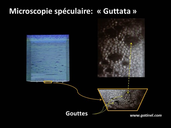 microscopie spéculaire: cornea guttata