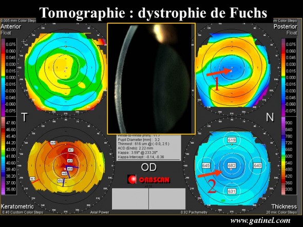 Orbscan : dystrophie de Fuchs