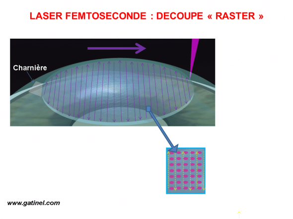 découpe laser femtoseconde capot LASIK