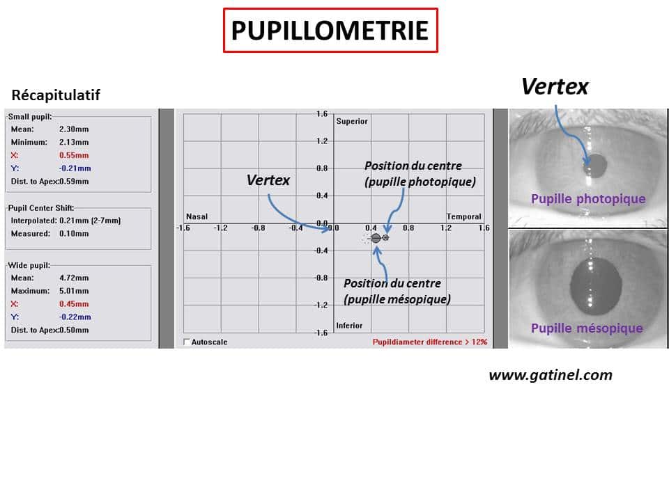 pupile dilatate la un examen ocular