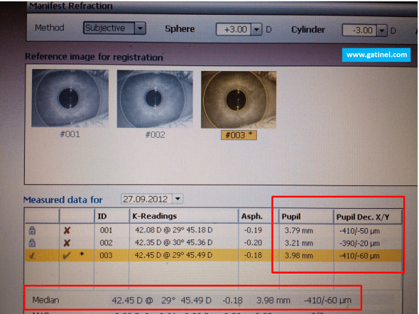 Several measurements are taken and provide information on the pupil diameter and location with respect to the apex (Pupil Dec. X/Y). A median value is computed from the various acquired examinations.  In this example, due to large angle Kappa, the pupil center at registration is located 410 micron temporally, and 60 micron inferiorly, to the apex. 