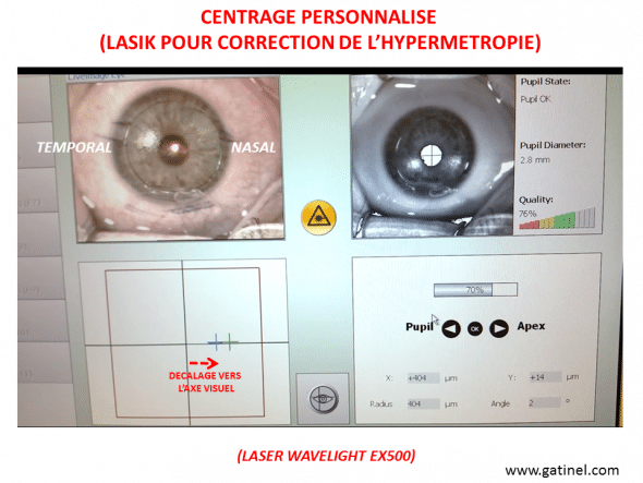 LASIK hypermétropie centrage personnnalisé grand angle kappa