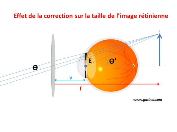L’objet sous-tend avec l’œil hypermétrope un angle ϴ avec la pupille d’entrée de l’œil (il s’agit de la taille angulaire apparente). L’œil corrigé « voit » l’objet correspondant à l’image formée par la lentille correctrice, sous un angle ϴ’. 