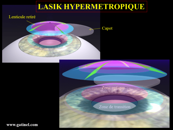 Représentation schématique du LASIK pour la correction de l’hypermétropie : le lenticule photoablaté comporte une partie destinée à la réalisation de la zone optique, qui est entouré d’une zone annulaire destinée à la réalisation du raccord avec la périphérie cornéenne (zone de transition). 