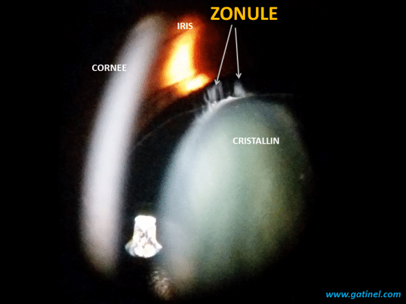 représentation de la zonule du cristallin