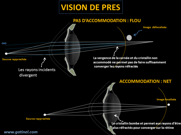 Pour un œil emmétrope, les rayons émis par les sources éloignées sont parallèles quand ils rencontrent l’œil, et convergent dans le plan de la rétine après réfraction par la cornée et le cristallin au repos. Pour une source rapprochée, les rayons rencontrent l’œil alors qu’ils divergent, et ceci oblige l’œil à accommoder pour augmenter sa puissance optique (vergence) et permettre aux rayons d’être réfractés pour être focalisés dans le plan de la rétine.  