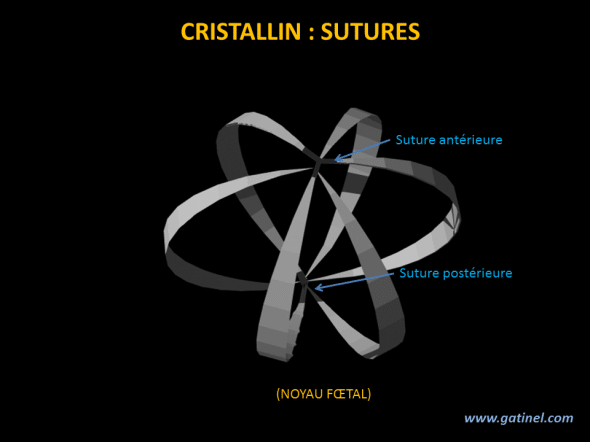 sutures du cristallin