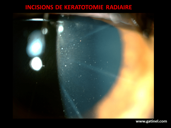 Détail des incisions de kératotomie radiaire: 8 incisions ont été réalisées, avec une zone centrale de 3 mm. 