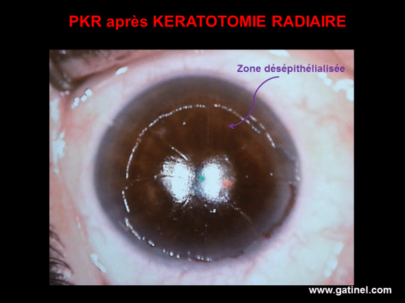 Au cours de la PKR indiquée pour corriger une hypermétropie secondaire après kératotomie radiaire, l’épithélium est retiré, avant que la correction au laser excimer soit délivrée sur le stroma cornéen. Le tracé des incisions est bien visible. 