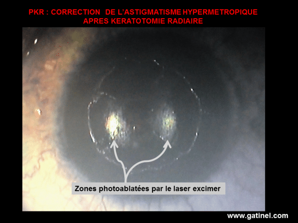 Cliché pris après la délivrance d’une correction de 2.50 Dioptries d’astigmatisme hypermétropique inverse (+2.50 x10°). L’œil avait été opéré de kératotomie radiaire (4 incisions) dans les années 90. 