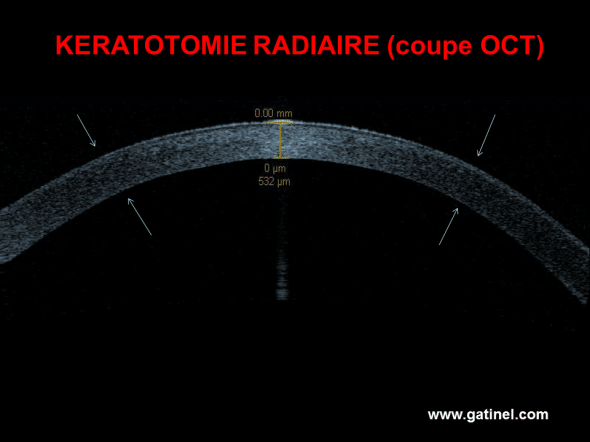 Cornée opérée de kératotomie radiaire (8 incisions) en coupe OCT. On observe une augmentation de la cambrure périphérique (flèche), en regard des incisions (non visualisées sur la coupe). La modification de la cambrure centrale est un aplatissement global (face antérieure et face postérieure). Bien que la résolution de cet OCT en soit pas assez élevée, on devine un épaississement épithélial central, qui « compense » partiellement l’aplatissement central induit par la relaxation périphérique. 