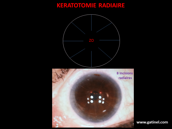 En haut: représentation schématique du tracé des incisions de kératotomie radiaire. La profondeur des incisions doit être proche de 90% de l’épaisseur cornéenne. L’effet de la KR est indirect: l’aplatissement souhaité de la zone optique (ZO) centrale, libre d’incision, est lié à la relaxation et la cambrure de la cornée périphérique. En bas :Œil opéré de kératotomie radiaire au début des années 90 : 8 incisions radiaires ont été réalisées pour corriger une myopie de 4.5 Dioptries. 