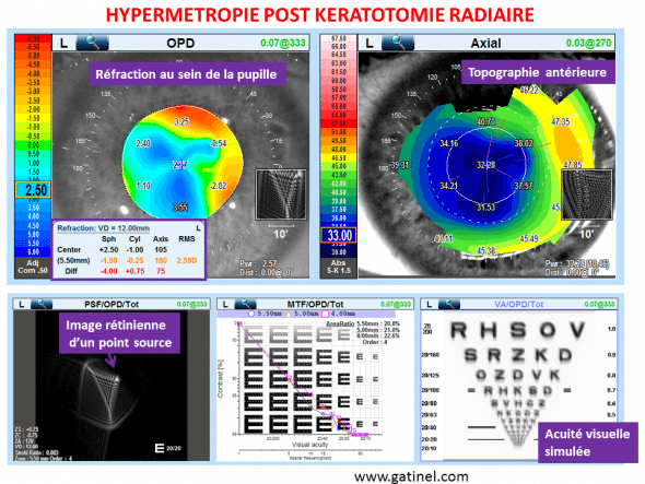 triplopie monoculaire kératotomie radiaire