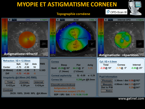 astigmatisme cornéen