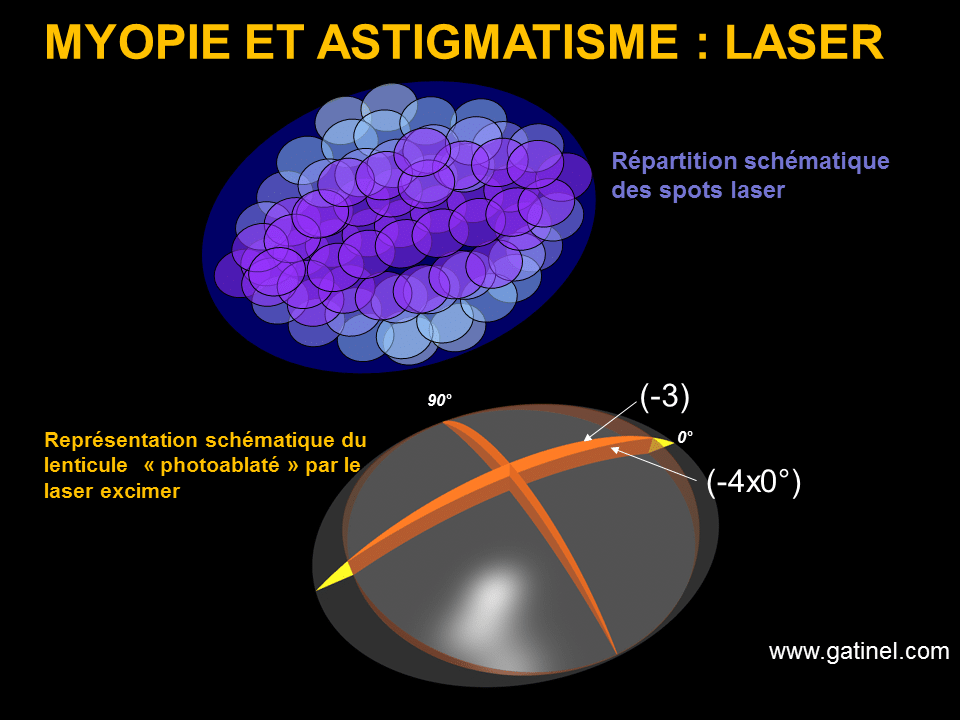 modele de myopie en 5 lettres