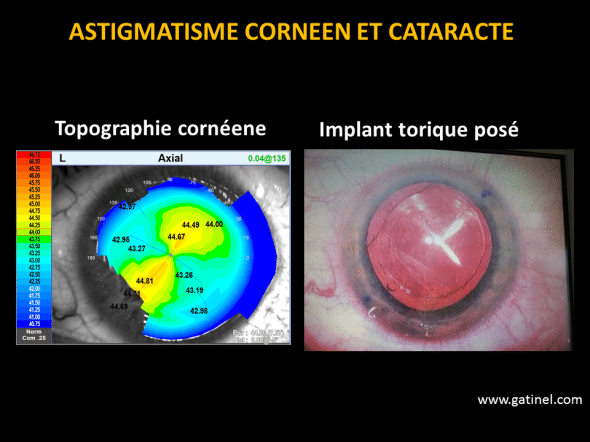 astigmatisme implant torique