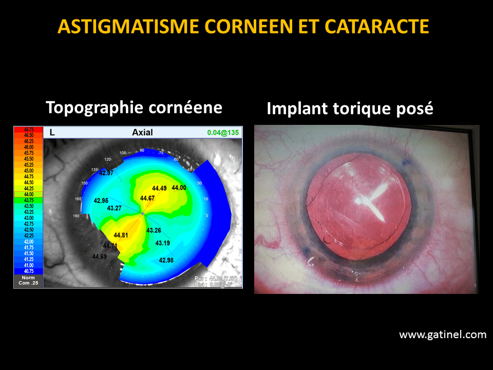 ostigmatism de miopie