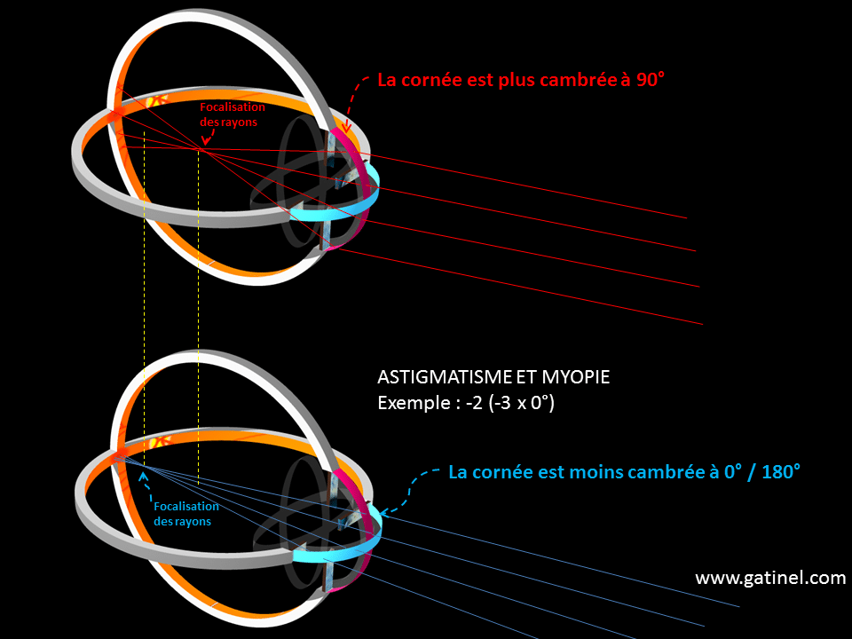 modele de myopie en 5 lettres