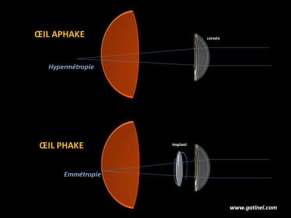 phake et aphake, hypermétropie induite