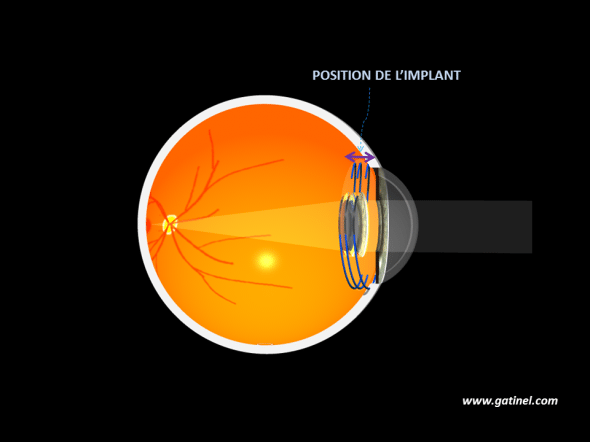Position de l'implant après l'intervention de cataracte