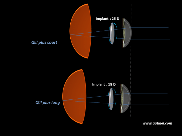 longueur axiale et puissance d'implant