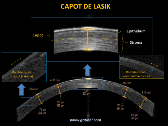 capot de LASIK en OCT