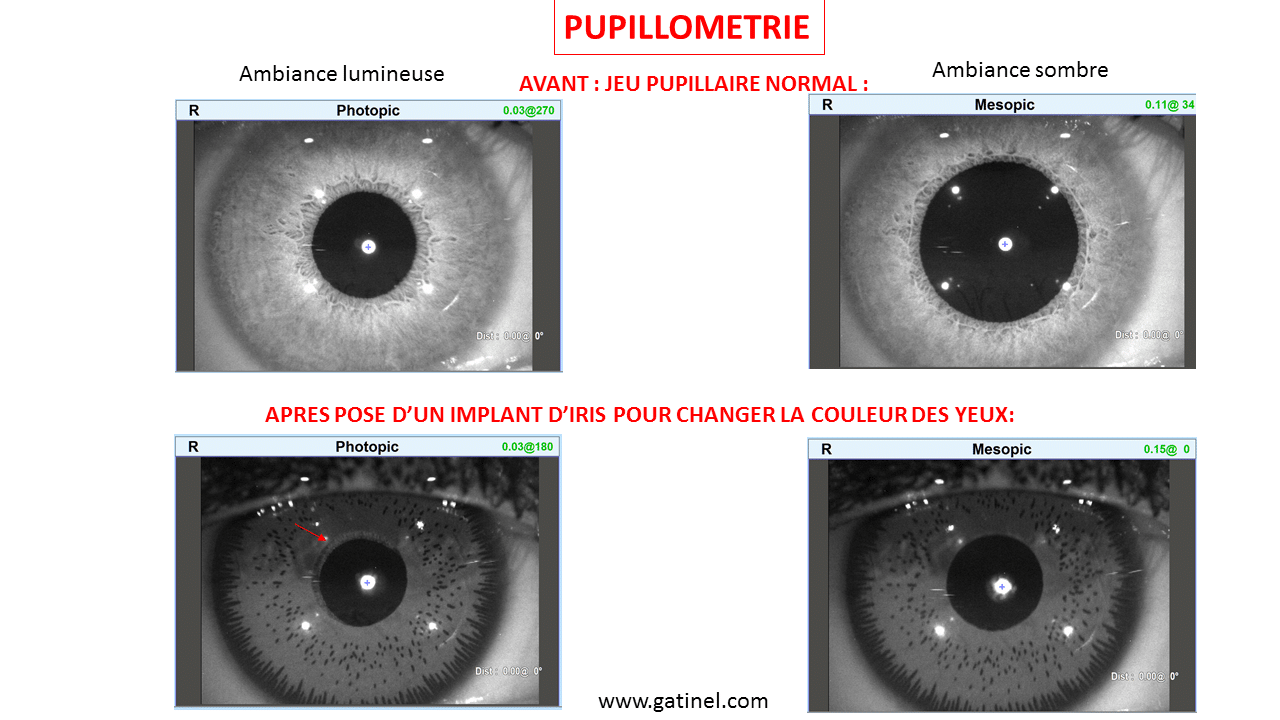 La Sensibilité des Yeux Clairs à la Lumières et les Risques