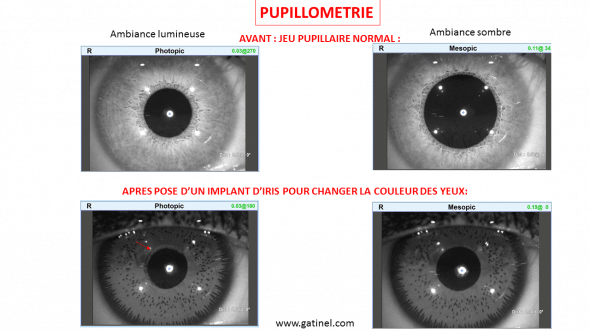 Implant iris pupillométrie