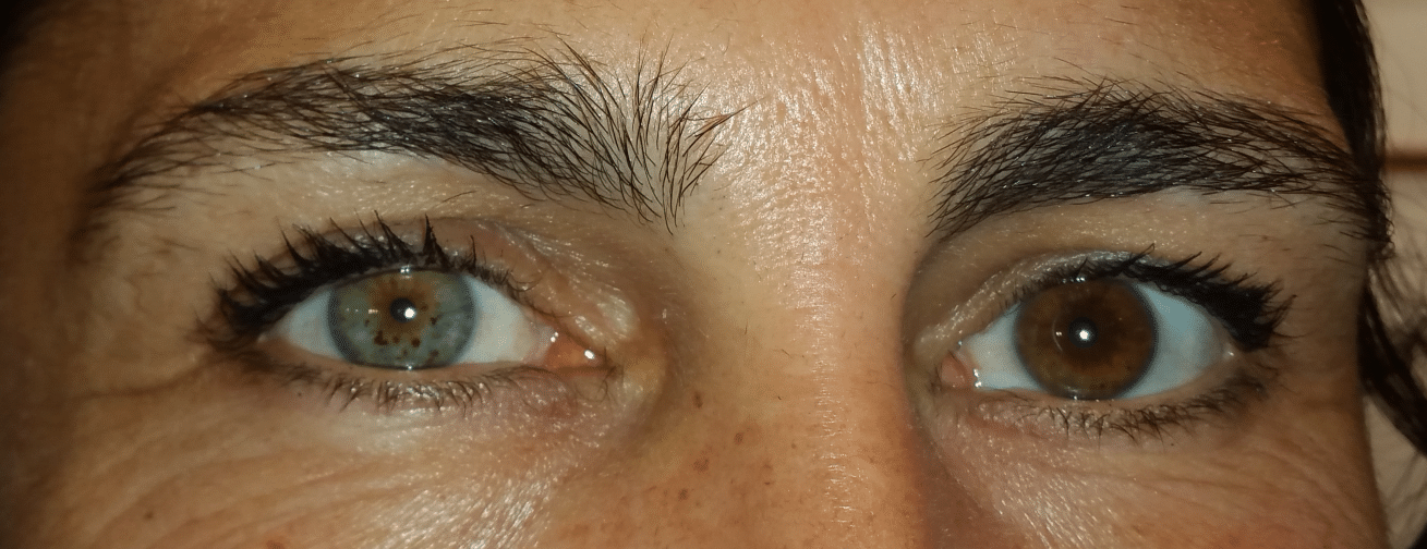 Iris et couleur des yeux - Docteur Damien Gatinel