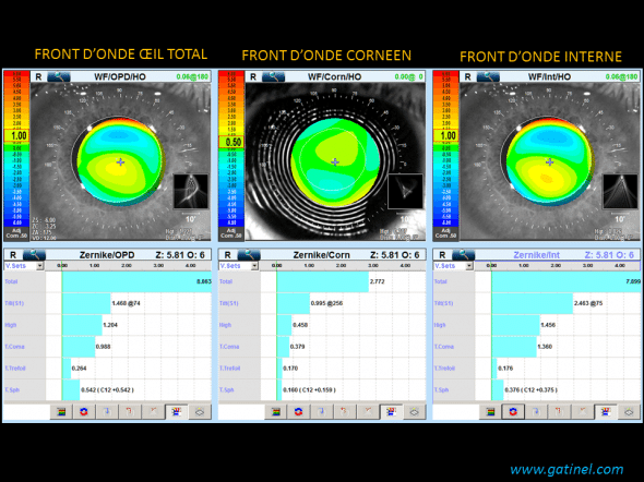 Le front d’onde oculaire de l’œil total est dominé par un taux élevé d’aberrations de haut de gré de type coma. Ces aberrations sont essentiellement induites par le cristallin (les cartes de front d’onde oculaire de l’œil entier et du front d’onde interne sont très proches). La PSF calculée pour le front d’onde interne présente un aspect en « queue de comète », que l’on peut corréler (à l’inversion rétinienne près) à la perception visuelle de la patiente (test du dessin de la perception d’un disque blanc). 
