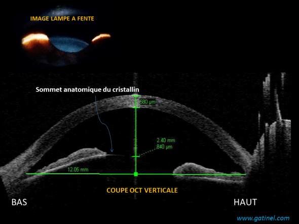 OCT : subluxation du cristalin
