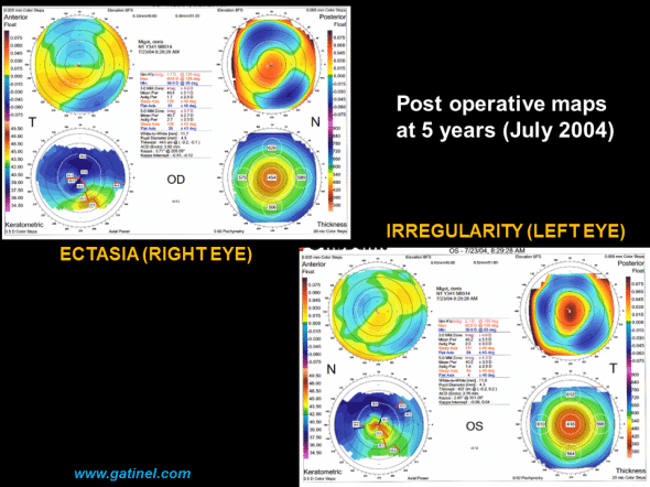 postoperative ectasia post LASIK Orbscan quadmap