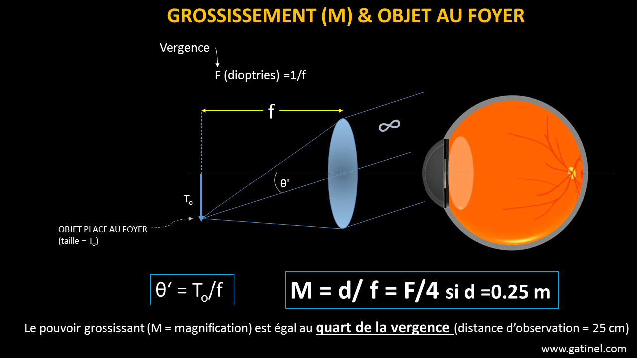 Loupe, grossissement - Docteur Damien Gatinel