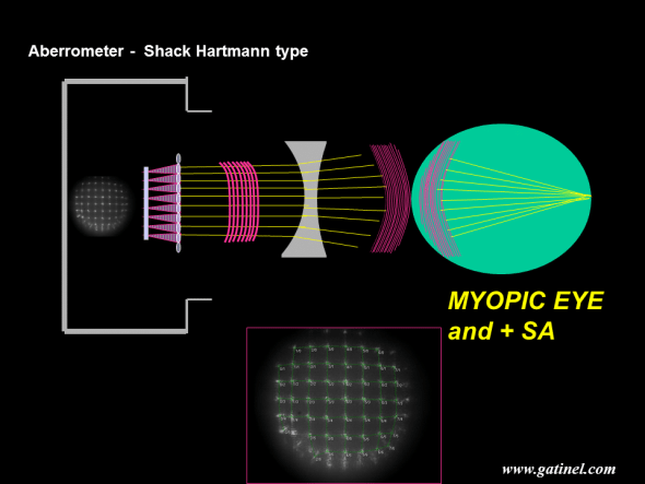 Schematic depiction of the wavefront reconstruction of a myopic eye with a Shack Hartmann aberrometer. In this example, the eye is not only affected by myopia, but some positive spherical aberration as well. Positive spherical aberration can be seen as an excessive myopic error close to the edge of the pupil. The spot array after refraction by the microlenselet array of the “flattest” possible wavefront is not regular but present some residual distorsion in the periphery. Positive spherical aberration would be caused by the induction of excessive phase advance for the wavefront periphery; due to this optical path difference, the peripheral rays may not interfere in phase with the central ones at the lens focal plane. The calculation of the wavefront error can be performed by measuring the distances between the actual spots and their expected positions, as this distance is proportional to the local slope of the wavefront. Now we have enough information to focus on the Zernike polynomials and their role in wavefront analysis. 