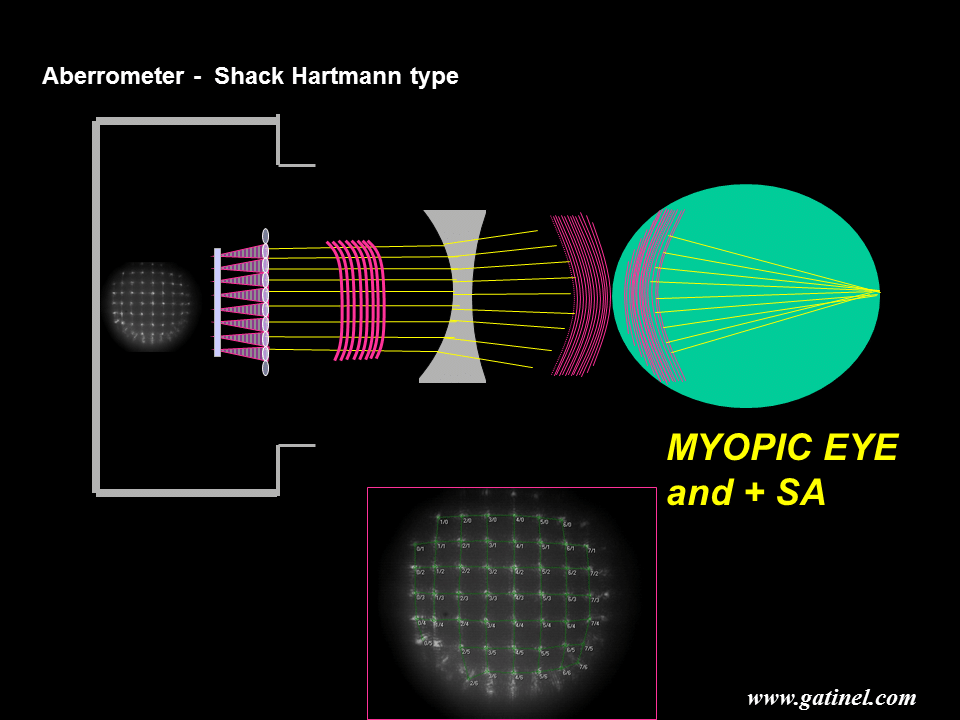 Aberrométrie, front d'onde: principes généraux - Docteur Damien Gatinel