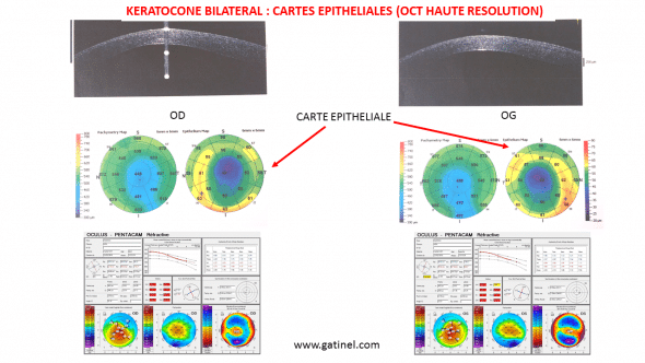 OCT haute résolution kératocône bilatéral