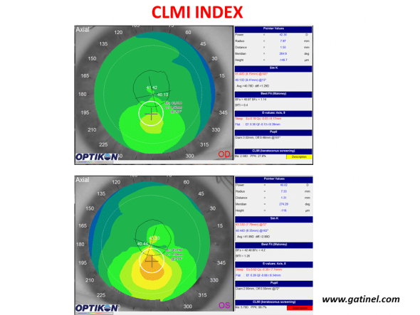 Use of the CLMI index with the Keratron Scout topographer (Optikon) for keratoconus screening. Maps are displayed in axial curvature mode. The right eye (top) presents keratoconus-suspect (PPK slightly higher than 25%, yellow colour code), while the left eye presents definite keratoconus (PPK close to 100%). 