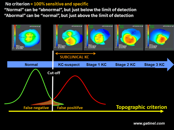 For an isolated index (or a group of indices), and regardless of the cut-off value adopted, a screening method based on a cut-off value is unable to discriminate between two populations (green: reference population, red: population with subclinical keratoconus), which, by definition, present similar characteristics. Comparison of the distributions of the values of the index in each population generally reveals a normal distribution and an overlap between the two populations. However, the cut-off value can be adjusted in order to minimize the false-positive and false-negative rates. 