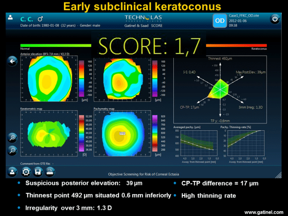 Right eye of a patient with advanced keratoconus of the left eye. Inspection of the maps (Quad Map) reveals the presence of slightly irregular inverse astigmatism and mean central corneal thickness slightly less than the mean (510 microns). The Radar map accentuates the difference between mean central pachymetry and the thickness value at the thinnest point; this value is correlated with a high thinning gradient (“Pachy thinning rate” on the map). The score is positive. 
