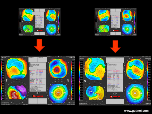 Despite persistence of a residual posterior wall thicker than 300 microns, the right eye presents features of corneal ectasia several months after bilateral LASIK. 