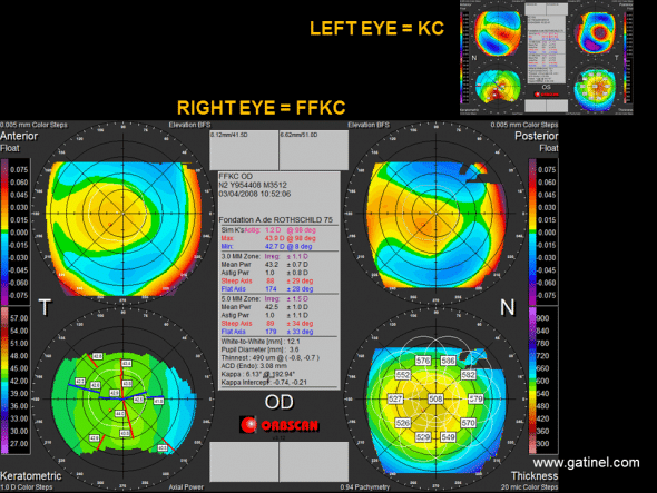 Orbscan Keratoconus vs Forme Fruste keratoconus