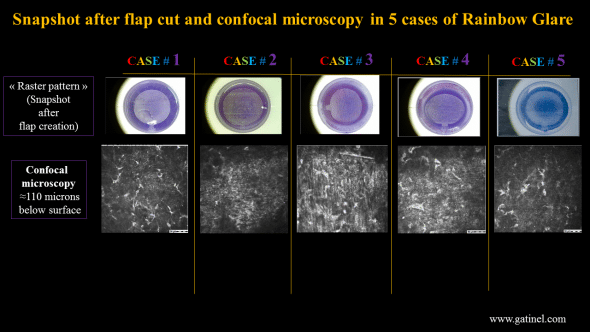 Images of the femtosecond laser flaps after their creation (top). Confocal microscopy at the flap interface, where hyperrelfective spot zone are clearly visible (presumbly located at the back surface of the flap).