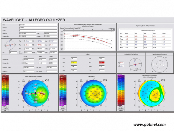 Positive keratoconus screening indices: the right eye presents an advanced form of keratoconus on the Pentacam corneal elevation topographer (Oculus, Germany). Mean corneal thickness is much lower than the mean, and the asphericity calculated for the principal semimeridians is highly prolate. 