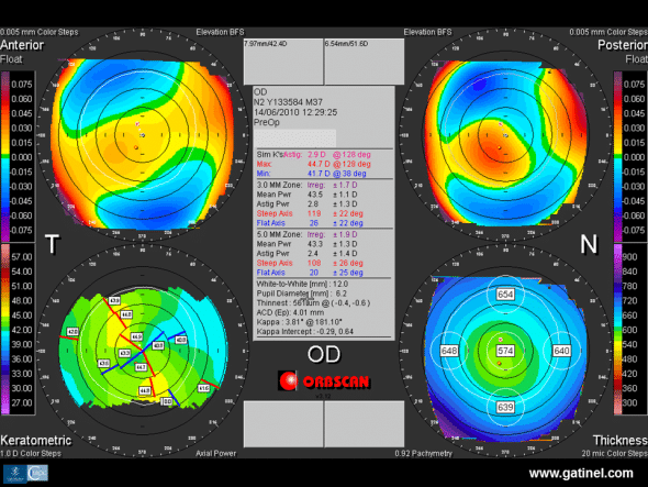 Preoperative Orbscan topography of the right eye in a 36-year-old candidate for LASIK for correction of compound myopic astigmatism. Note the corneal toricity responsible for slightly irregular oblique astigmatism (SRAX), with marked posterior central elevation and mean central corneal thickness higher than the mean. 