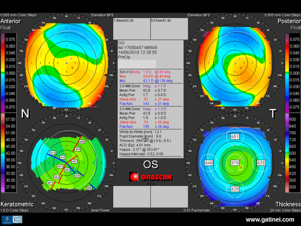 Preoperative Orbscan topography of the left eye: corneal toricity is responsible for slightly irregular oblique astigmatism. Mean central corneal thickness is higher than the mean, and similar to that of the right eye. 