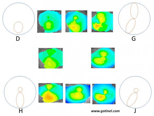 Schematic patterns and corresponding examples (with intermediate forms) of corneas at risk of subclinical keratoconus according to Rabinowitz et al. These appearances were obtained on axial curvature (Placido anterior corneal topography) using an absolute scale, and arbitrarily identified by a letter of the alphabet between A and J. Only appearances particularly suspicious of early keratoconus are presented here: D: Isolated inferior steepness G: Skewed Radial Axes (SRAX) H: Asymmetric Bow tie (AB) J: Combination of forms G and H: this pattern is designated by the acronym AB/SRAX: this appearance is a risk factor for progression to clinical keratoconus. Note that areas of warm colour do not correspond to “bumps”, but regions in which the anterior corneal surface presents excessive steepness. 