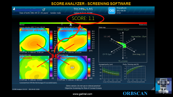 The final SCORE Analyzer GUI provides 3 additional graphs to the classic ORBSCAN quad-map display: – the SCORE bar, which visually locates the SCORE value on a linear color scale bar. – the RADAR map display, which is a new visually appealing and efficient map to help the clinician to appreciate the value of 6 pertinent corneal topography derived indices – the averaged pachymetry and pachymetry thinning curves, which provide meridionally-averaged cross sectional analysis of the corneal thickness profile. Before the final GUI was finalized in 2011, we explored a range of different versions: this creative process wandered in several directions as we imagined various sketch proposals. Some of these are displayed hereafter: