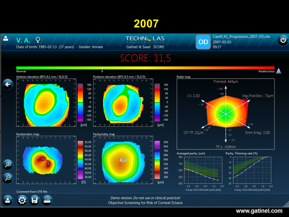 Progression of keratoconus. SCORE software map (right eye) in a patient with keratoconus, calculated retrospectively from the Orbscan examination performed in 2007. 