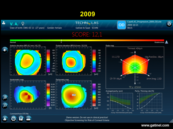 SCORE software map (right eye) in this same patient with keratoconus, calculated retrospectively from the Orbscan examination performed in 2009. Graphic comparison of colour topography maps does not indicate any progression of keratoconus. However, the score is higher, and the values of most of the indices of the radar map are also higher. The corneal thinning rate is considerably higher. 