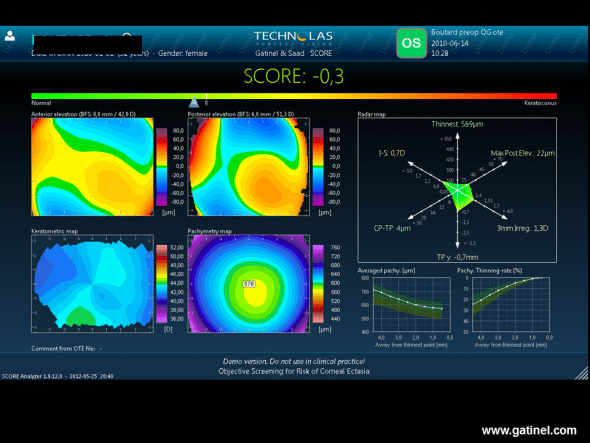 The score for the fellow eye calculated from the Orbscan examination performed before LASIK is slightly negative. The Radar map demonstrates the presence of vertical curvature asymmetry and inferior vertical decentration of the thinnest point. 